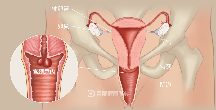 请问宫颈息肉需要做手术吗？