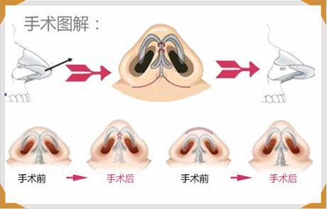 鼻翼整形大概多少钱