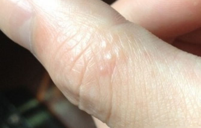 请问手指上长很多小水泡是怎么回事？还很痒。