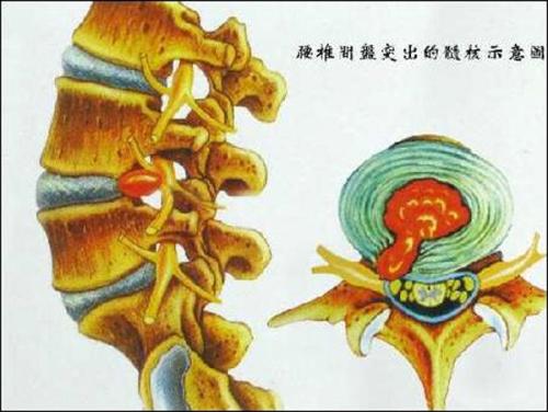 椎间盘膨出是什么意思