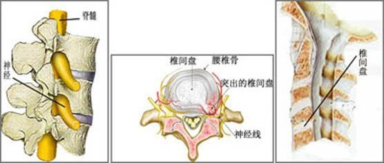 椎间盘膨出是什么意思