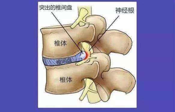 椎间盘膨出是什么意思