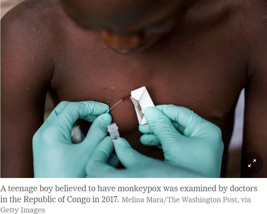 美专家称猴痘疫情在美国有失控风险，猴痘病毒有何特点？