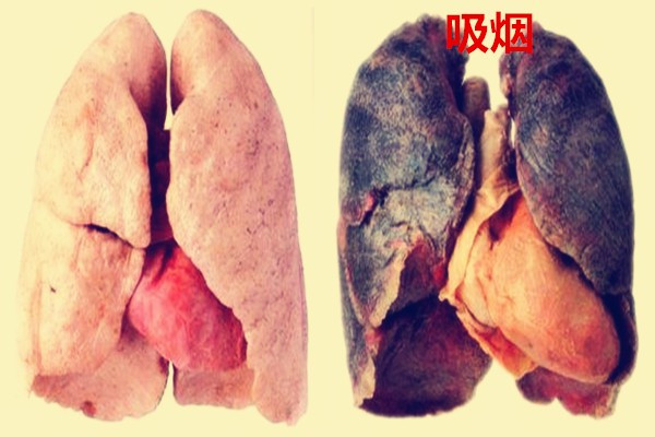 吸烟者的肺（图片）