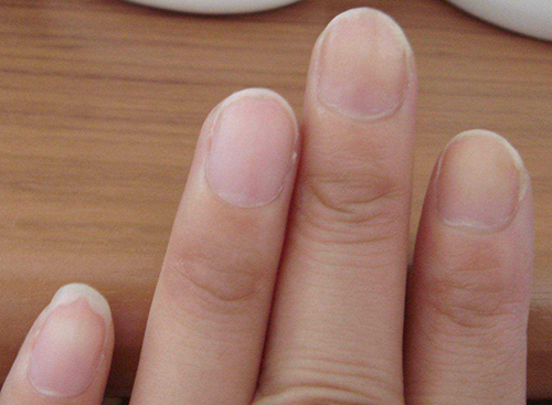 女人手指甲上有竖纹是怎么回事