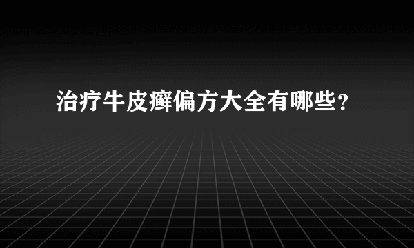 治疗牛皮癣偏方大全有哪些？