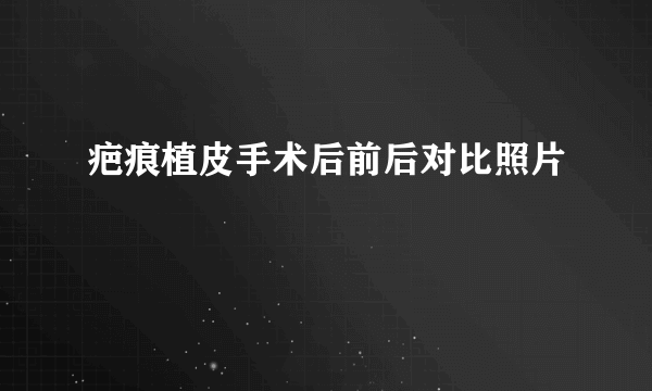 疤痕植皮手术后前后对比照片