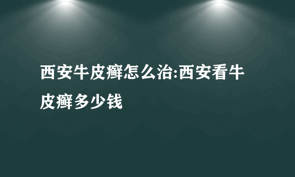 西安牛皮癣怎么治:西安看牛皮癣多少钱