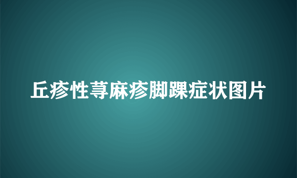 丘疹性荨麻疹脚踝症状图片